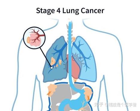 肺癌基因检测检查费用_肺癌基因检测费用_肺癌基因检测机构医院认可吗